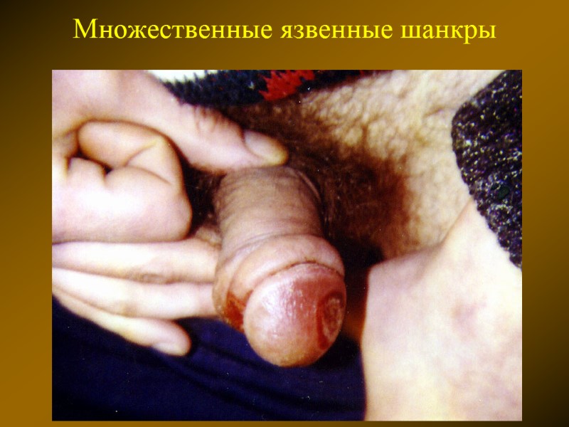 Множественные язвенные шанкры